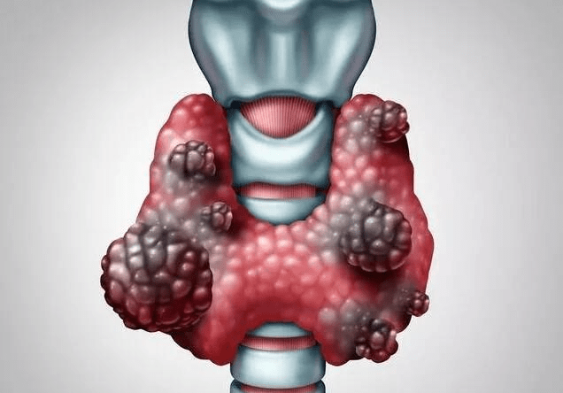 甲状腺专家王占荣提醒:甲状腺癌早期,常出现这3种症状!