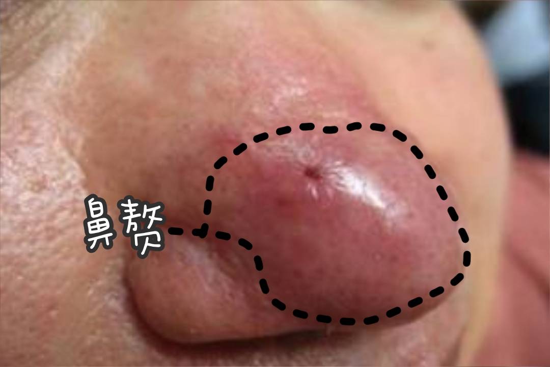3,鼻赘期如:鼻子变大的时候,用手轻轻一碰还伴有疼痛感.