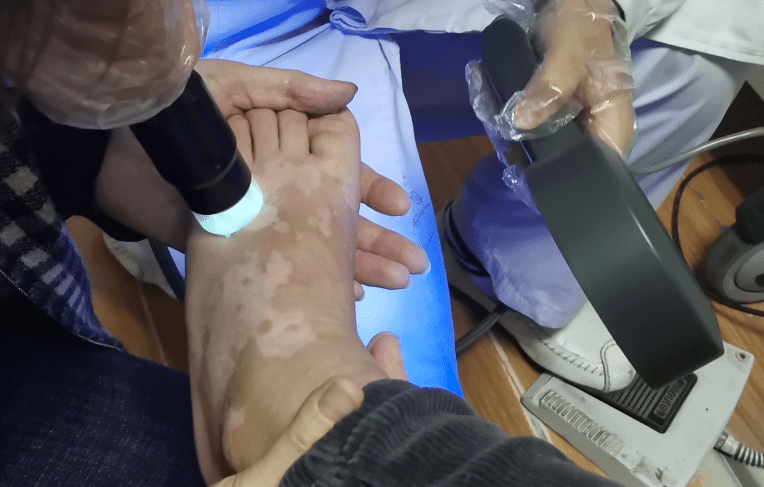 白癜风治愈率高达80%，关键是找对方法，白癜风治疗方法之光疗