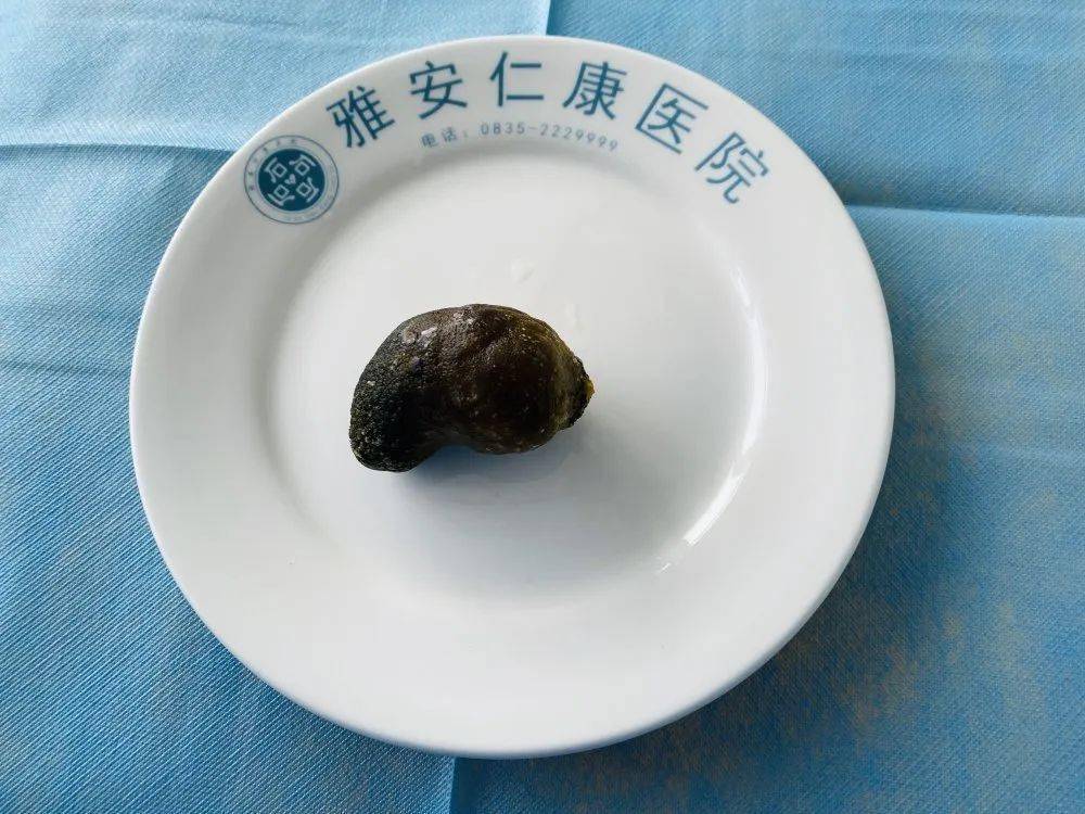 疯狂的石头丨人体内形状各异的石头
