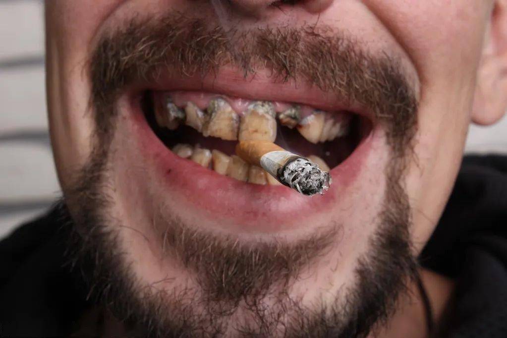 长期的吸烟可以造成口腔内色素沉着,使牙齿变得又黑又黄,影响牙齿的