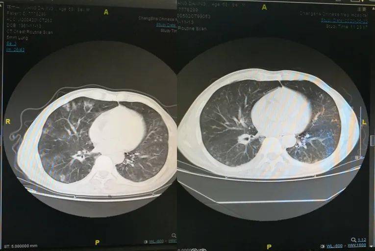 莫大意吸入性肺炎后果很可怕