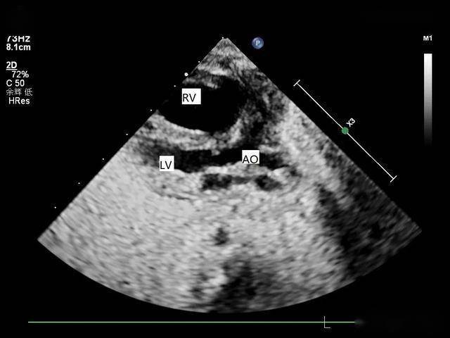 超声医生如何理清诊断思路完全性肺静脉异位引流心下型