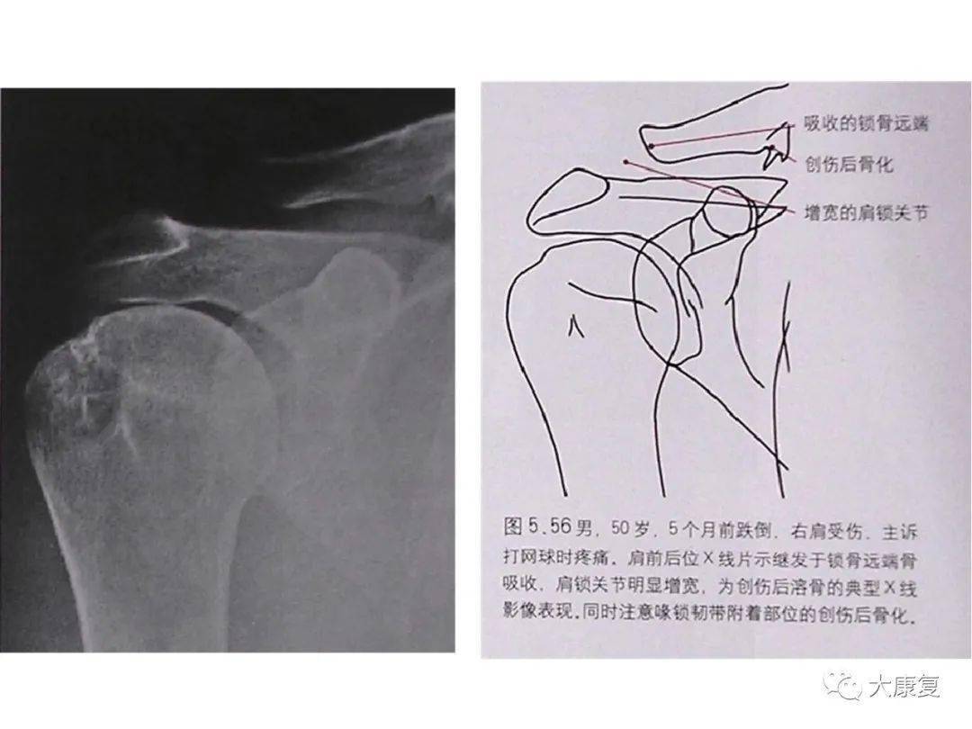 肩关节运动损伤影像诊断