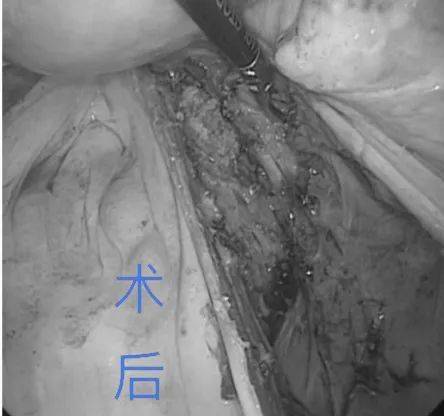 后腹膜肿瘤多为恶性,据国外报道恶性约占80%,成为威胁人们健康的重大