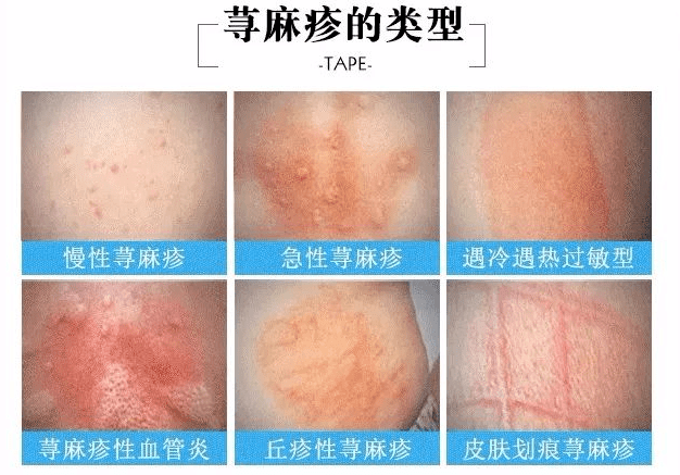 大腿到腰痒得想哭!经常犯,这病该怎么治?