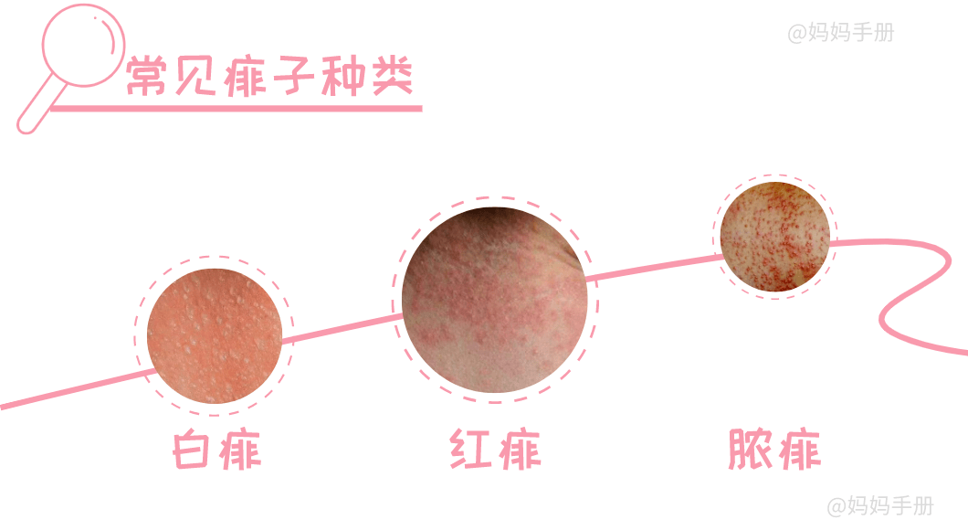 孩子|都是因为这件事没做好！夏天孩子皮肤红肿、刺痒、蓄脓