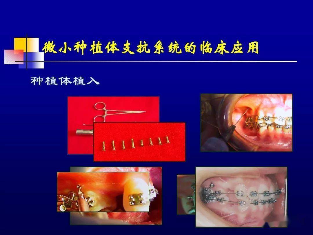 种植体支抗在正畸临床的应用