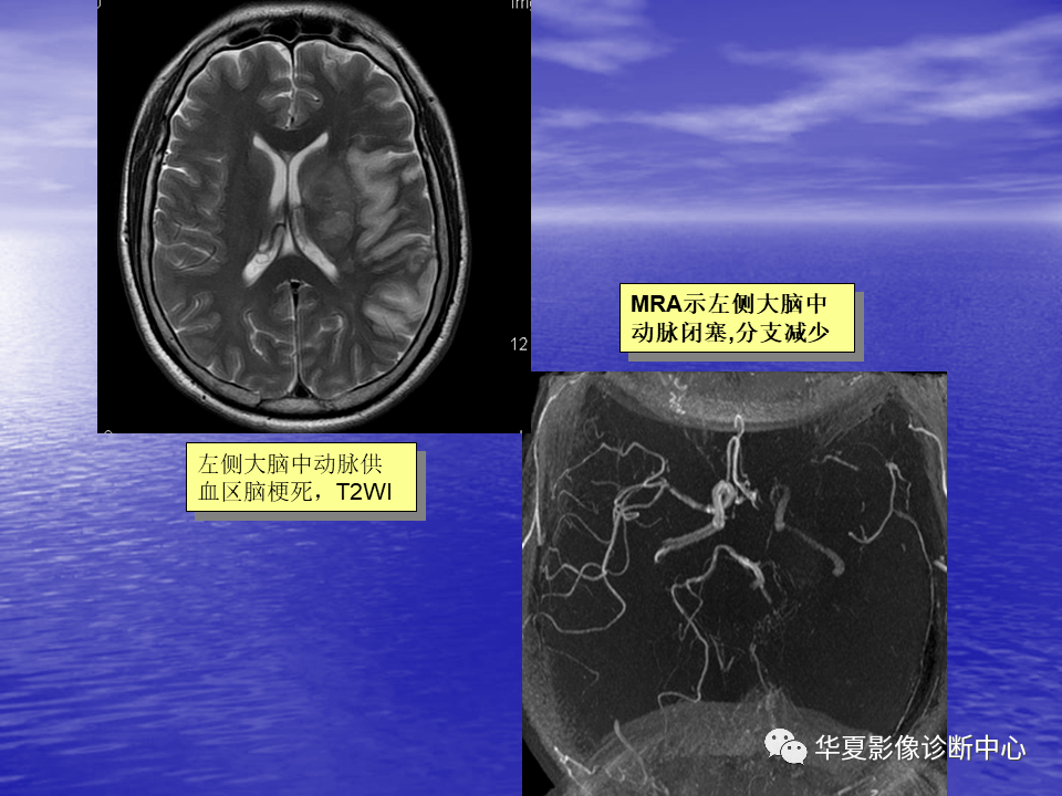 不容错过丨脑血管病变的mri学习