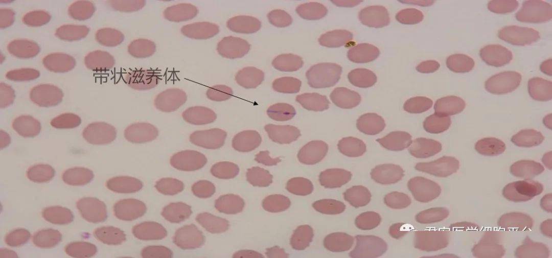 图片讨论顾剑飞老师:在涂片镜检时,发现有白细胞吞噬裂殖体的现象