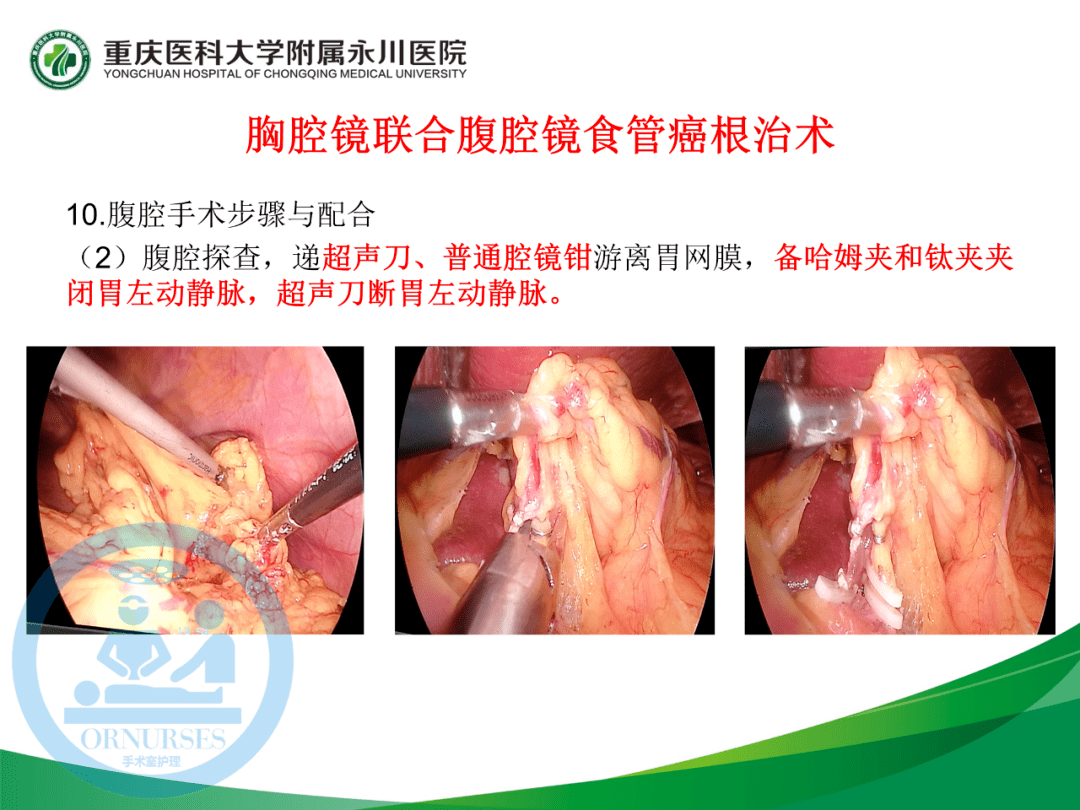 ppt胸腔镜联合腹腔镜食管癌根治术的手术配合