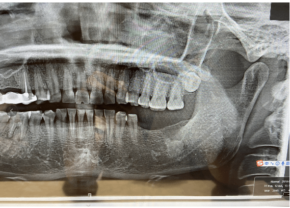 周老师解析 可能是牙骨质瘤,也可能是由于拔牙后炎症没有刮除干净而
