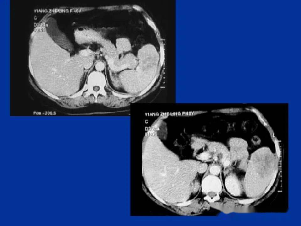 脾脏疾病的ct 诊断