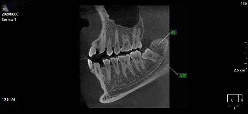 ct示:38,48近中阻生,均双根,根尖均偏舌侧,神经管偏颊侧,均未压迫同侧