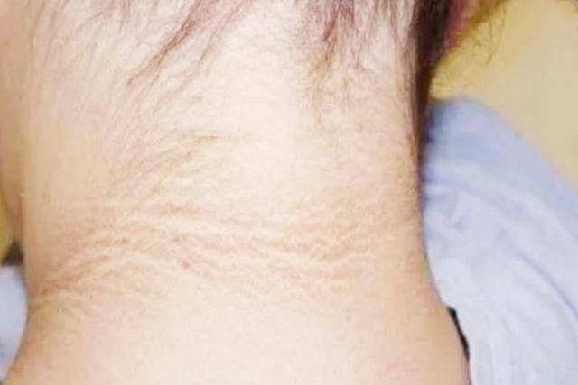 显示小玉确实是生病了,但这种病却是  由肥胖引起的,叫"黑棘皮病"