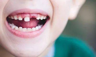 针对6岁左右儿童,口腔科已开展窝沟封闭技术;针对小朋友牙齿爱