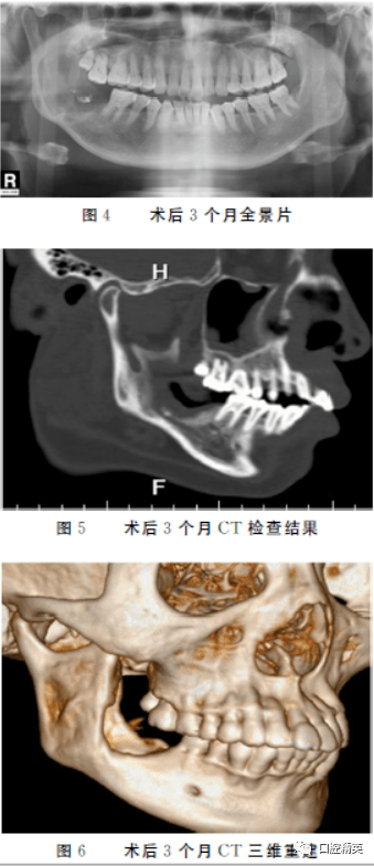 口内入路摘除治疗下颌骨巨大型颌骨囊肿1例及文献复习