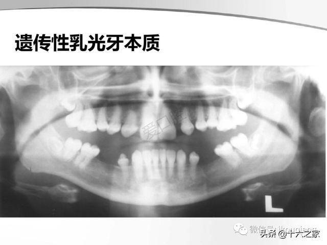 牙及牙周各种疾病影像学表现整理