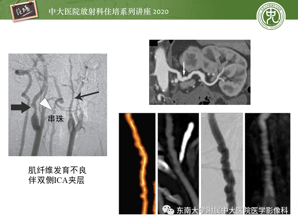 颈动脉夹层及夹层动脉瘤的影像诊断及评估