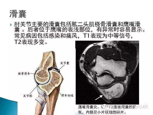 影像解剖肘关节mri图谱超全整理