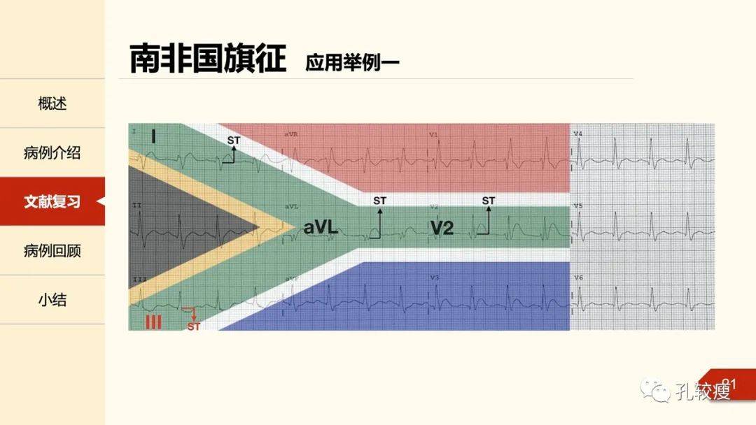 南非国旗征一种判断对角支闭塞的心电图表现