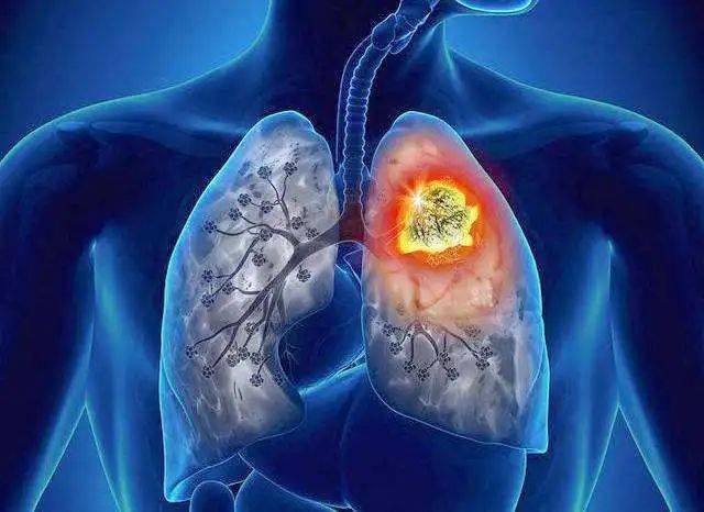 肺结节就是肺癌吗?看胸外科专家怎么说!