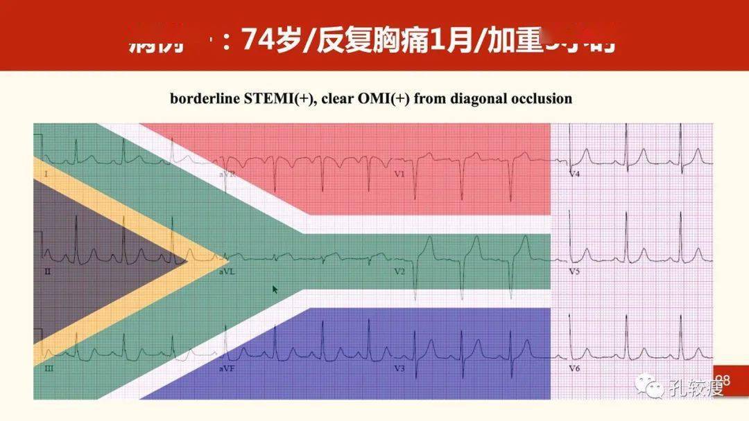 南非国旗征一种判断对角支闭塞的心电图表现