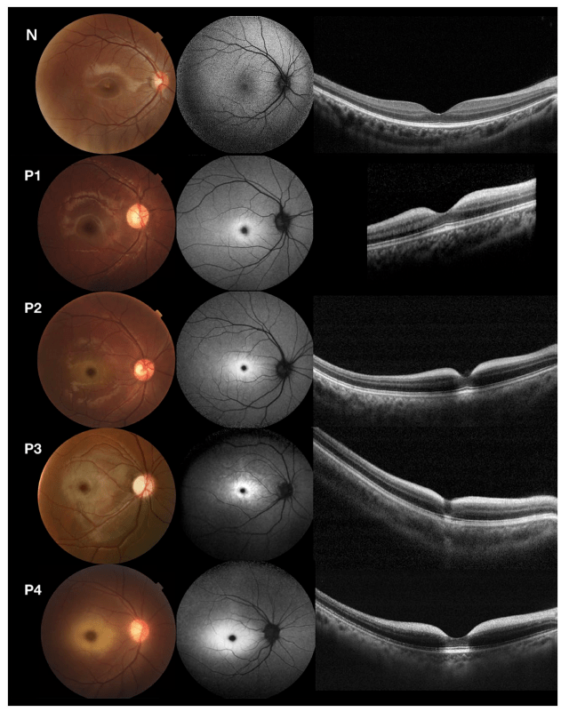 图1. 正常人和4名患者的眼底彩照,faf和oct检查结果