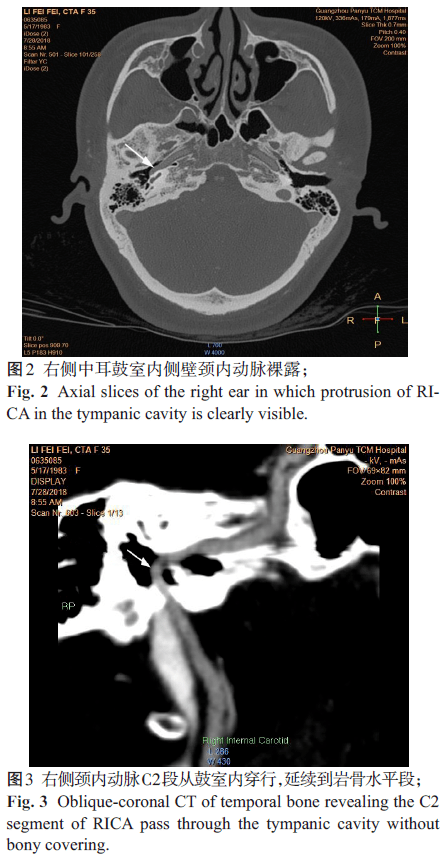 鼓室内异位颈内动脉1例