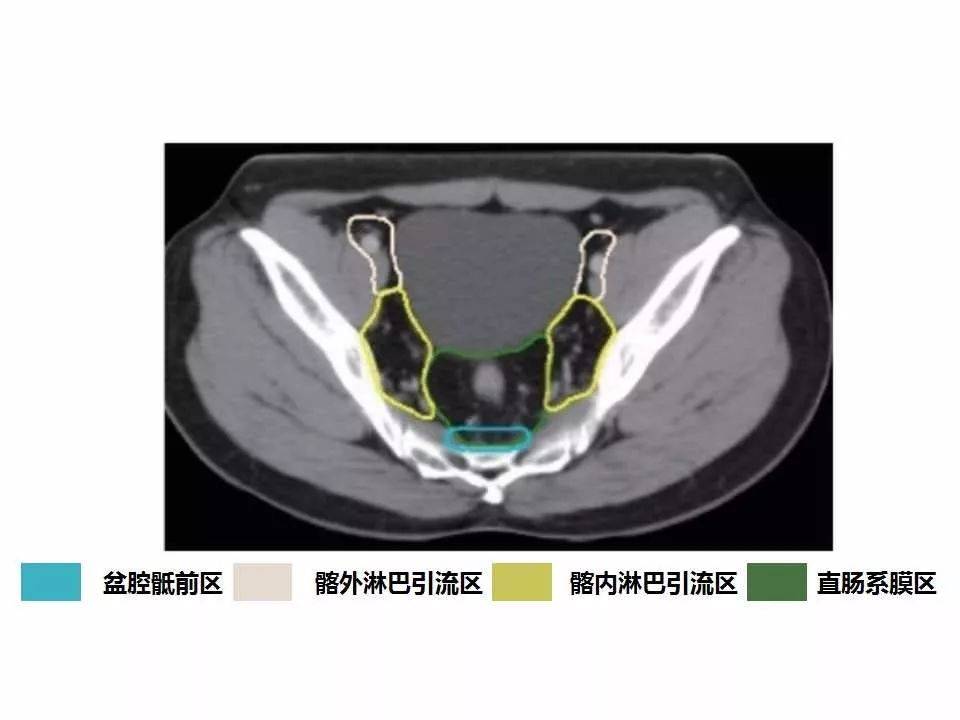 高清版直肠癌淋巴引流区图谱