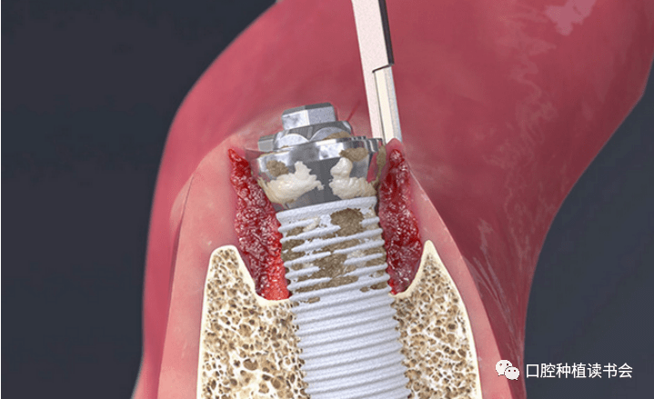 种植体周围炎的软硬组织重建治疗上