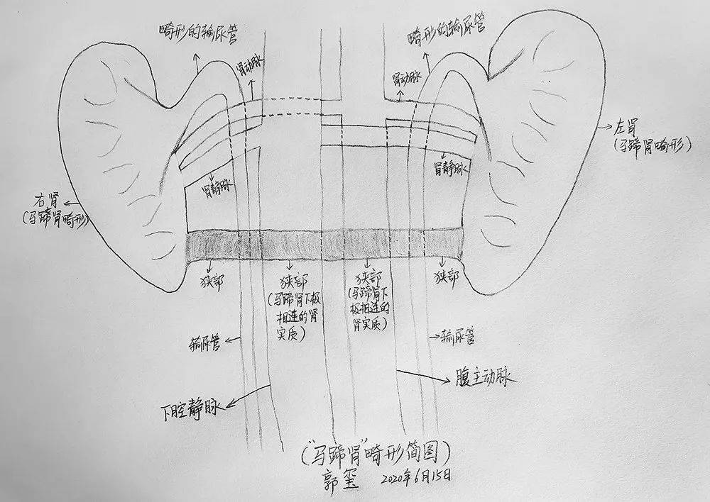 先天性融合肾怎么办