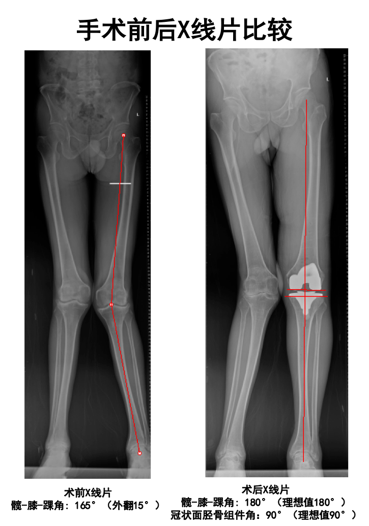 膝关节置换医院排名_膝关节置换图片(2)