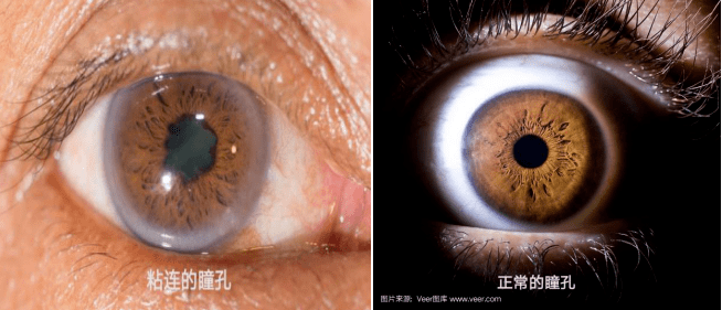 在白内障手术前需要用药物把瞳孔散大到以下图片中的状态才能进行手术
