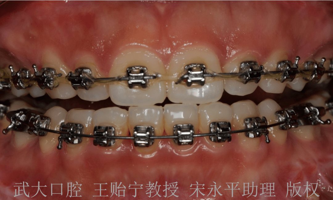 漂白进展及对口腔修复的影响