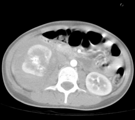 郑祥|广州云浮两地联动，花季少女成功保肾