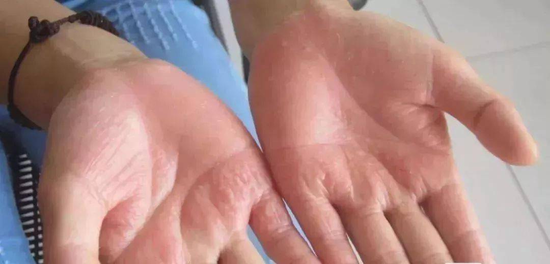 一到夏天手上就长小水疱汗疱疹别挑破艾灸止痒防复发