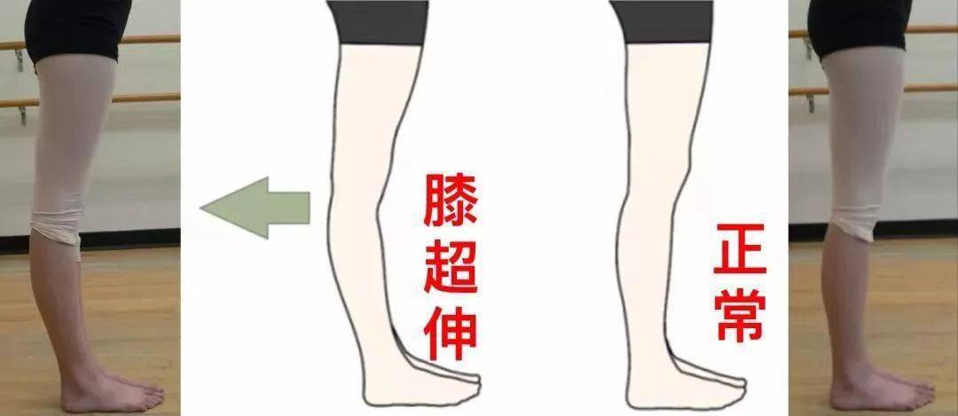 假使自然站立时「髋部,膝盖,脚踝 」不正在一条垂线上,即是膝过伸.