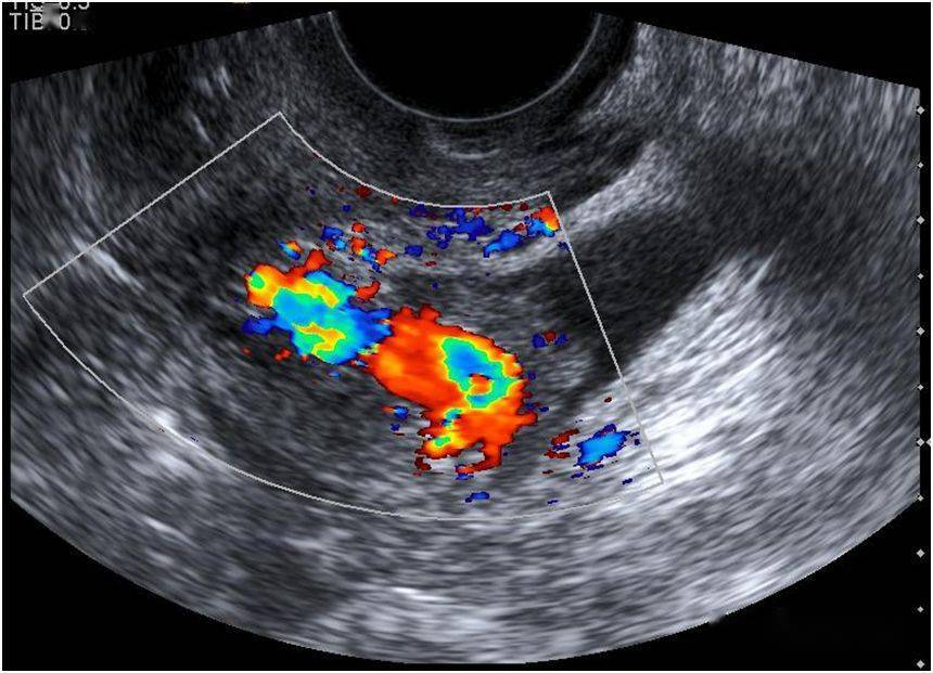 超声典型病例子宫穿孔