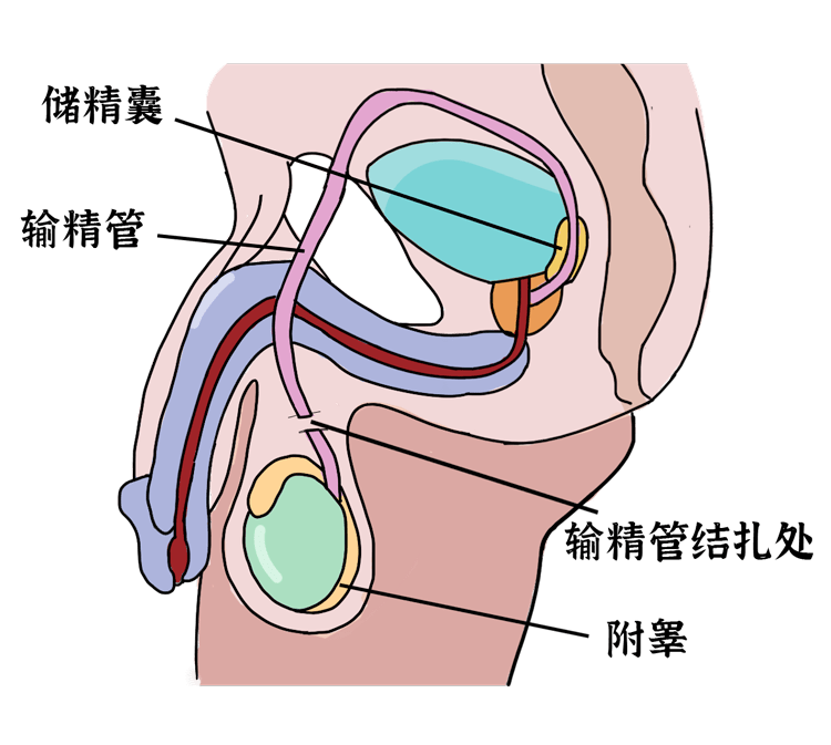 这一来 小蝌蚪就会被锁在蛋蛋里 从根本上避免了怀孕 因为输精管位置