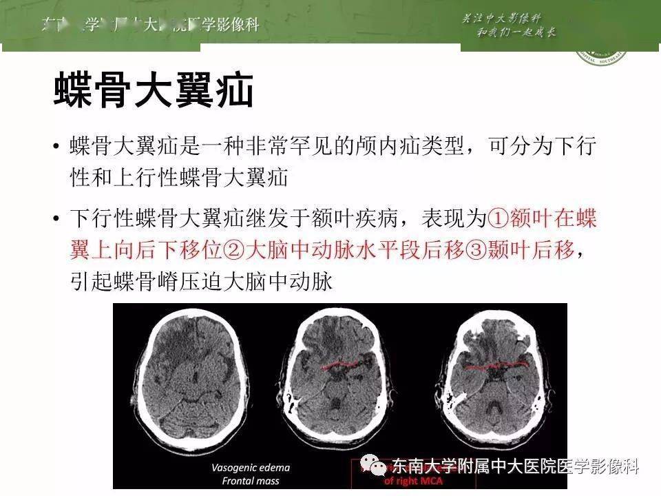 病例1病史女,67岁,因"头部外伤15小时,突发意识不清2小时"入院ct病例2
