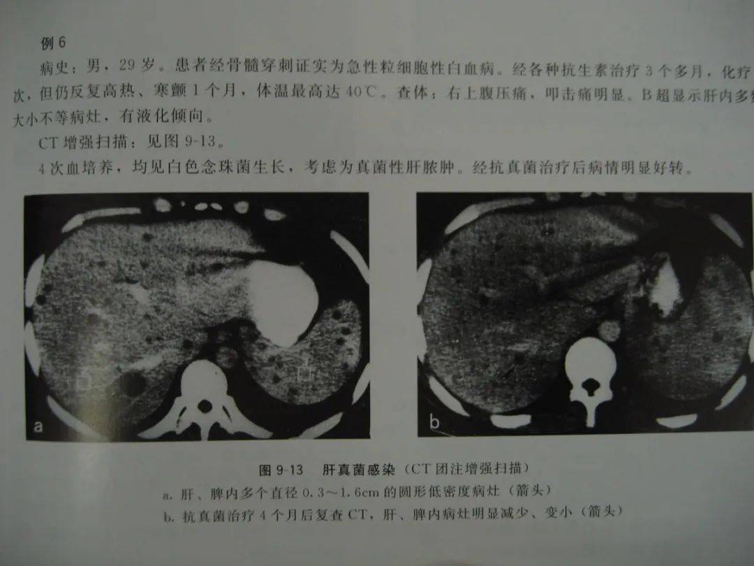 图1-11 脂肪肝声像图-腹部超声简易-医学