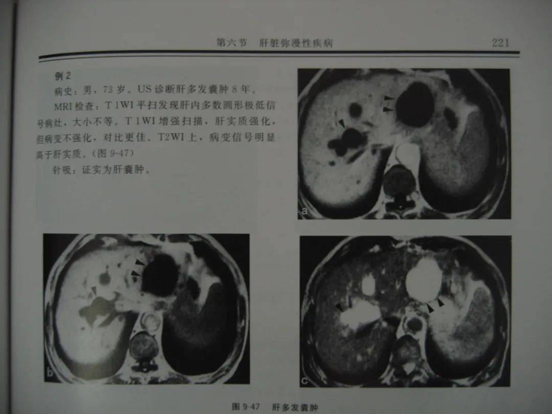 七、肝豆状核变性-临床超声诊断学-医学
