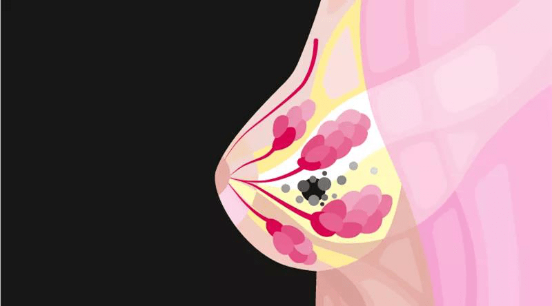“一看二摸”不靠谱，女性乳房健康看这里