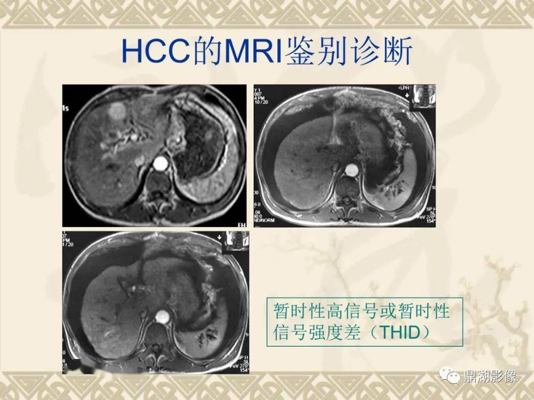 师说| 肝硬化结节的ct和mri表现(陈星荣教授)