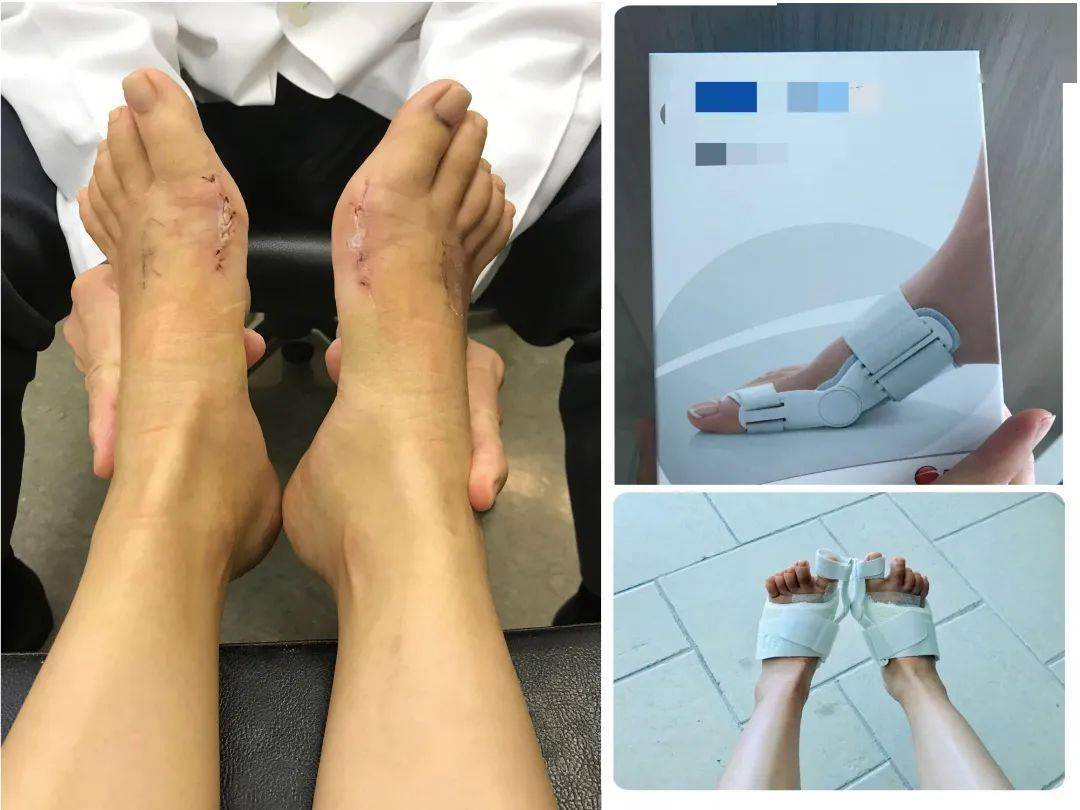 术后  第四个月,恢复理想,可以除去石膏,借助拐杖慢慢正常走路了.