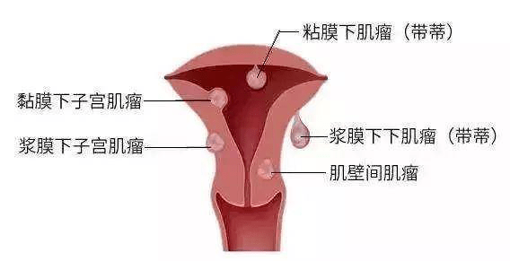 子宫肌瘤按照肌瘤与子宫壁的关系可分为肌壁间肌瘤,浆膜下肌瘤及粘膜