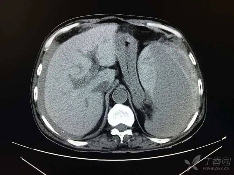 查上腹部 ct 示:脾大,脾破裂,腹腔积液,积血(图 5).