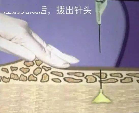 3.帮助患者放松心情,减轻注射部位肌肉紧张状态.