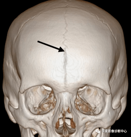 五,缝间骨缝间骨为位于颅缝间的多余骨块,多位于颅骨矢状缝和人字缝
